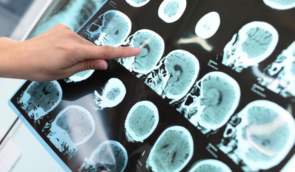 Plymouth dementia expert welcomes potential drug breakthrough